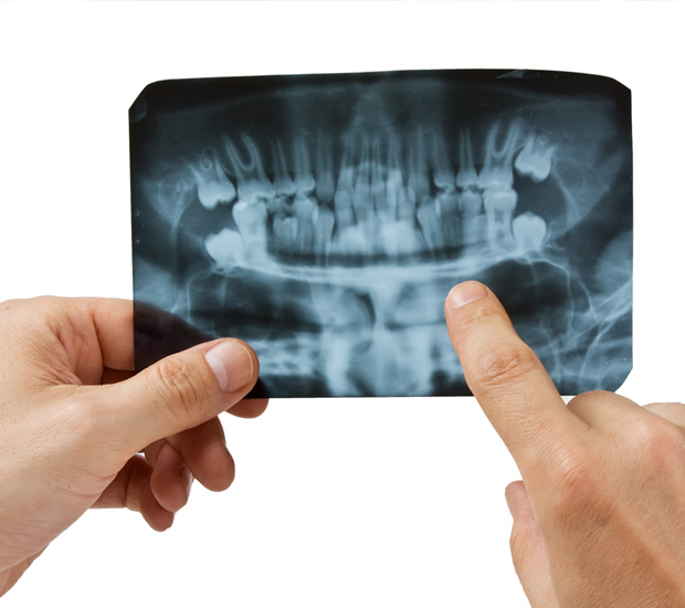 Ijamsville 7 Signs You Need Endodontic Surgery
