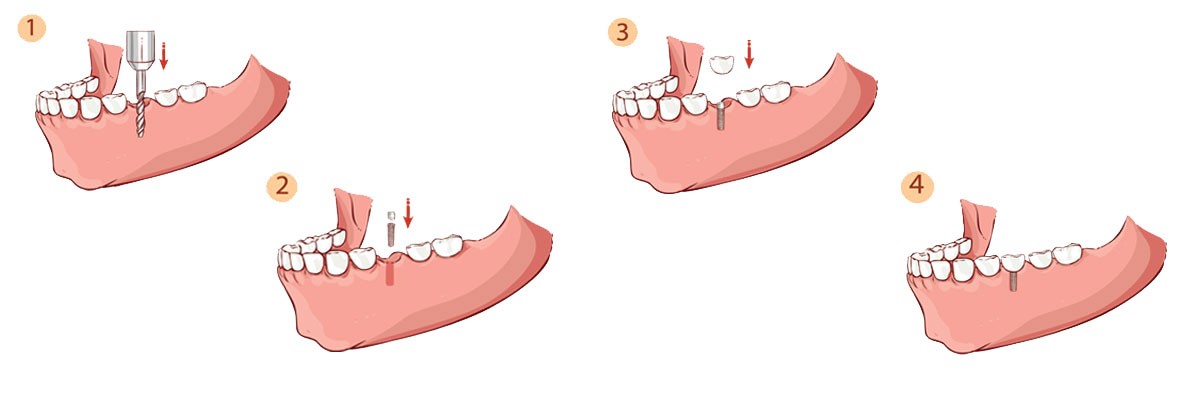 Ijamsville The Dental Implant Procedure