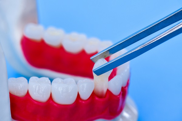 Eating And Speaking With Dental Implants