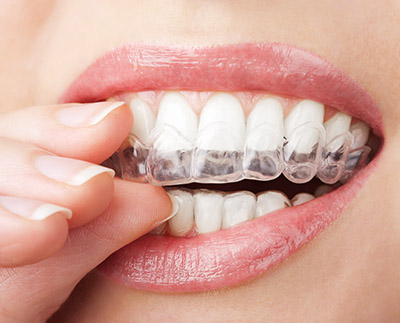 Does Invisalign Really Work?