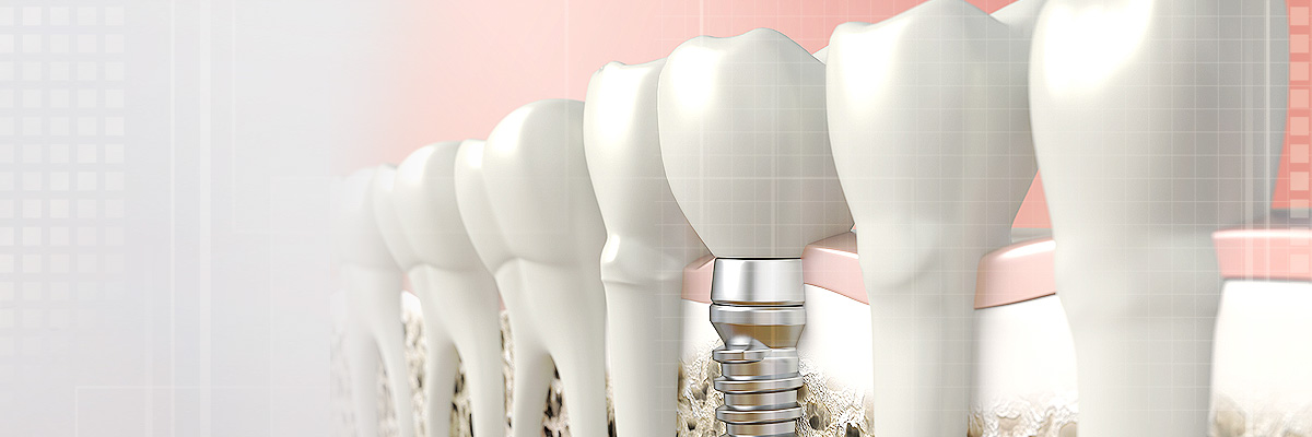 Ijamsville Implant Dentist