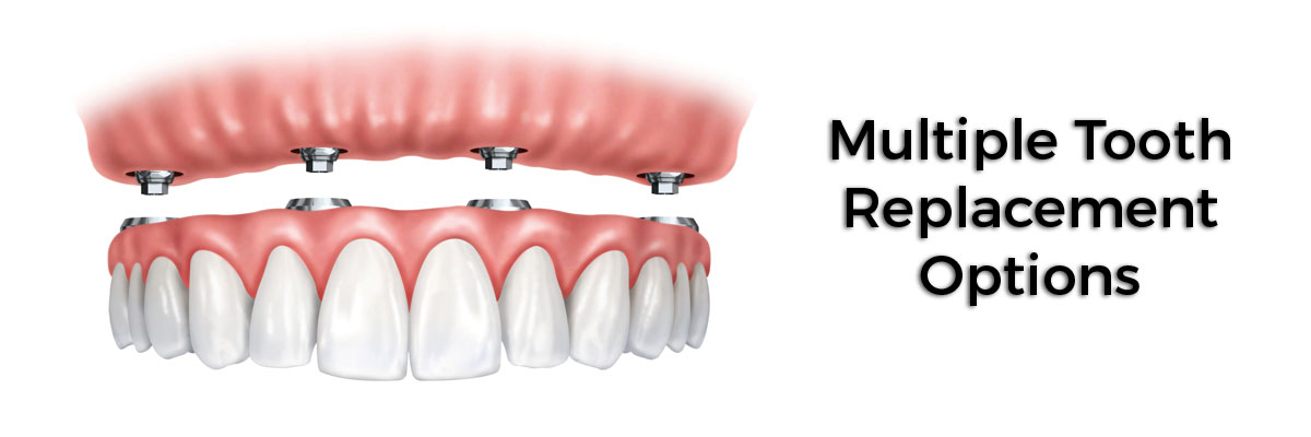 Ijamsville Multiple Teeth Replacement Options