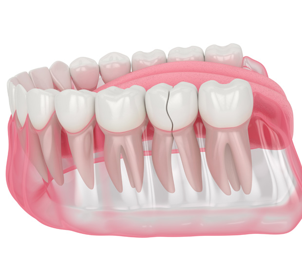 Ijamsville Types of Dental Root Fractures