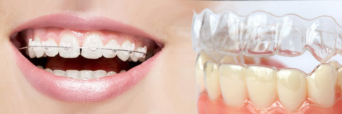 Ijamsville Which is Better Invisalign or Braces
